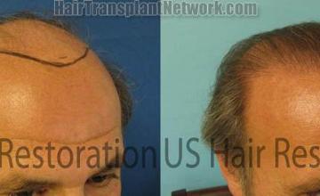 Right view before and after hair transplantation