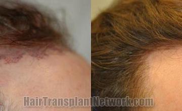 Hair transplantation surgery before and after pictures