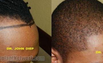 Hair restoration procedure before and after results