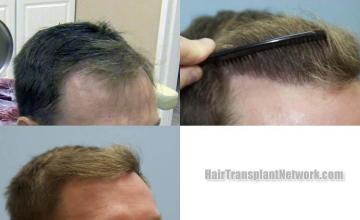 Hair restoration procedure before and after results