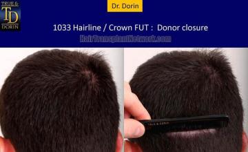 Hair transplant surgery before and after photos