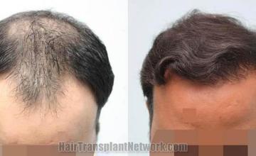 Top view before and after hair restoration results