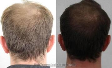 Hair transplantation surgery before and after pictures