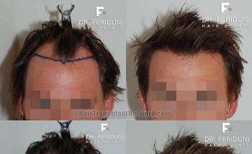 Hair restoration procedure before and after results