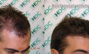 Hair restoration procedure before and after pictures