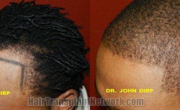 Hair transplantation surgery before and after photos