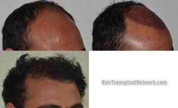 Hair transplantation surgery before and after photos