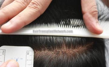 Surgical hair transplantation result photographs