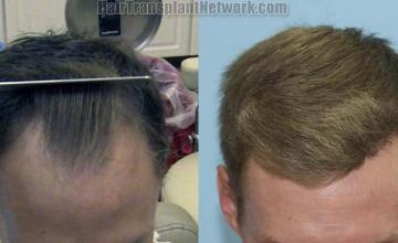 Top view before and after hair restoration results