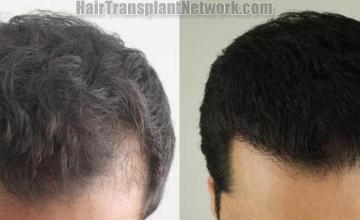 Hair restoration procedure before and after results