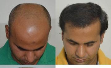 Hair transplantation surgery before and after images