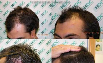 Hair replacement surgery before and after images