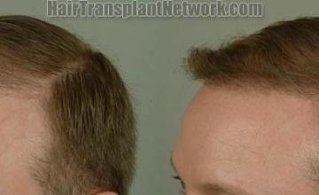 Hair transplantation surgery before and after images