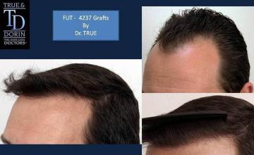 Hair transplantation surgery before and after photos