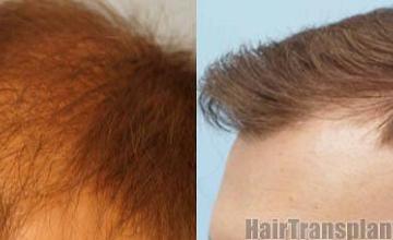 Hair transplantation surgery procedure before and after photos