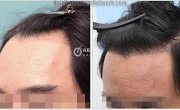 Hair transplantation surgery before and after photos