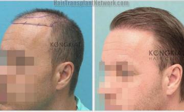 Hair transplantation surgery before and after photos