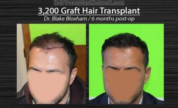 Hair restoration surgery before and after images