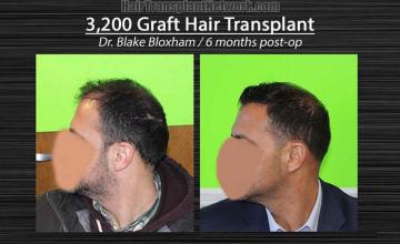 Hair transplantation surgery before and after photos