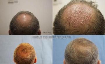 Hair transplantation surgery before and after pictures