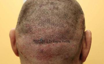 Hair transplantation surgery before and after pictures