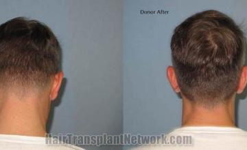 Hair transplant surgery before and after photos