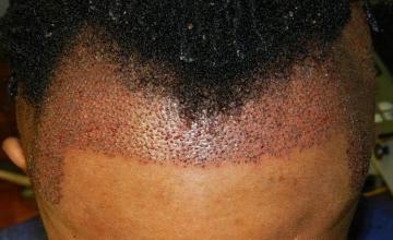 Hair transplantation surgery immediate postoperative image