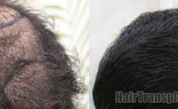 Right view before and after hair restoration images