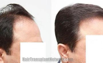 Hair restoration procedure before and after results