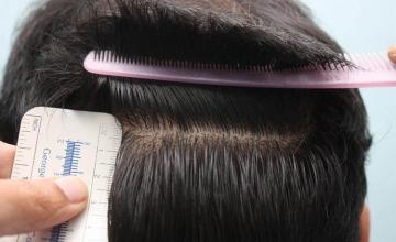 Hair restoration surgery before and after images