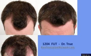 Top view - Before and after hair transplant photos