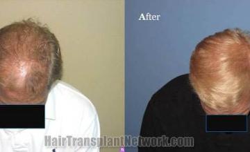 Top view before and after hair restoration