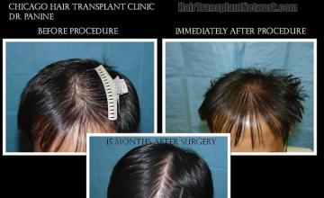 Top view - Before and after hair transplantation photos