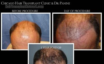 Hair restoration procedure before and after results