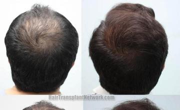 Hair restoration procedure before and after pictures