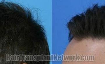Before and after hair transplantation procedure