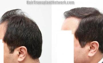 Hair transplantation surgery before and after photos