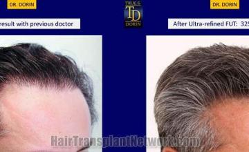 Hair transplantation surgery before and after photos