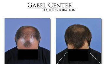 Top view before and after hair restoration results