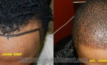 Before and after hair transplant procedure images
