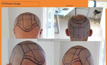 Hair restoration surgery before and after photos