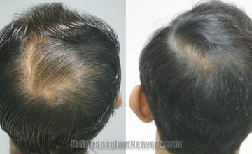 Back view before and after hair restoration procedure