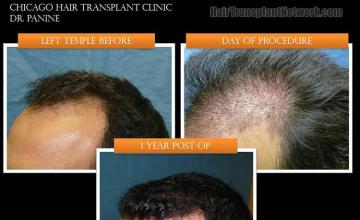 Hair transplantation surgery before and after pictures