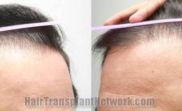 Hair transplantation surgery before and after pictures