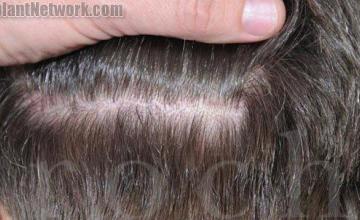 Residual scar from hair transplant donor area