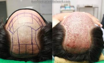 Hair restoration procedure before and after pictures