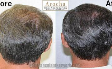 Hair transplantation surgery before and after pictures