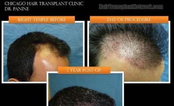 Hair restoration procedure before and after results