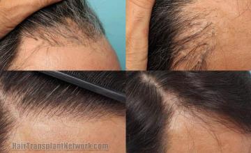 Hair transplantation surgery before and after images