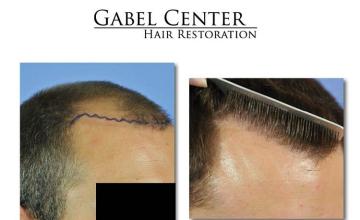 Hair replacement surgery before and after images